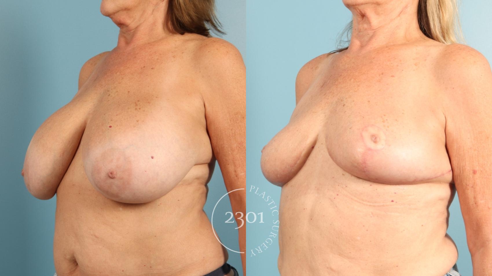 Before & After Breast Reduction Case 957 Left Side View in Fort Worth, Plano, & Frisco, Texas