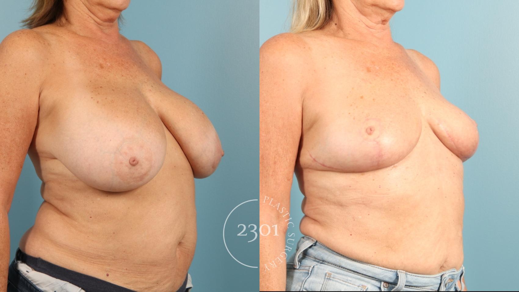 Before & After Breast Reduction Case 957 Right Oblique View in Fort Worth, Plano, & Frisco, Texas