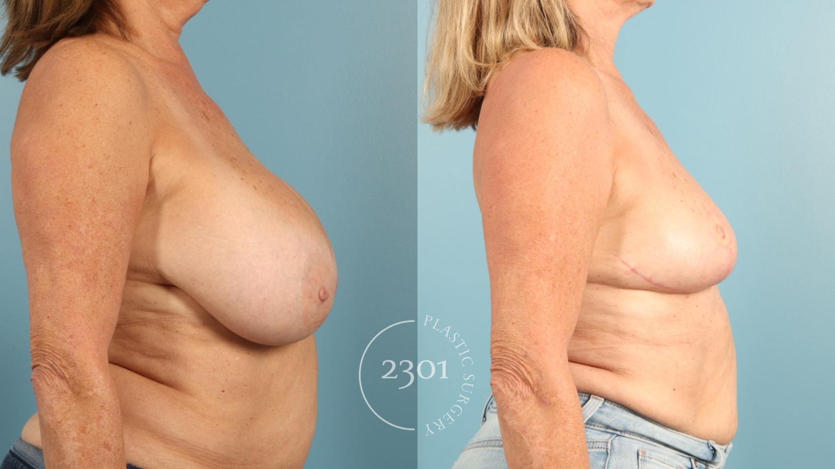 Before & After Breast Reduction Case 957 Right Side View in Fort Worth, Plano, & Frisco, Texas