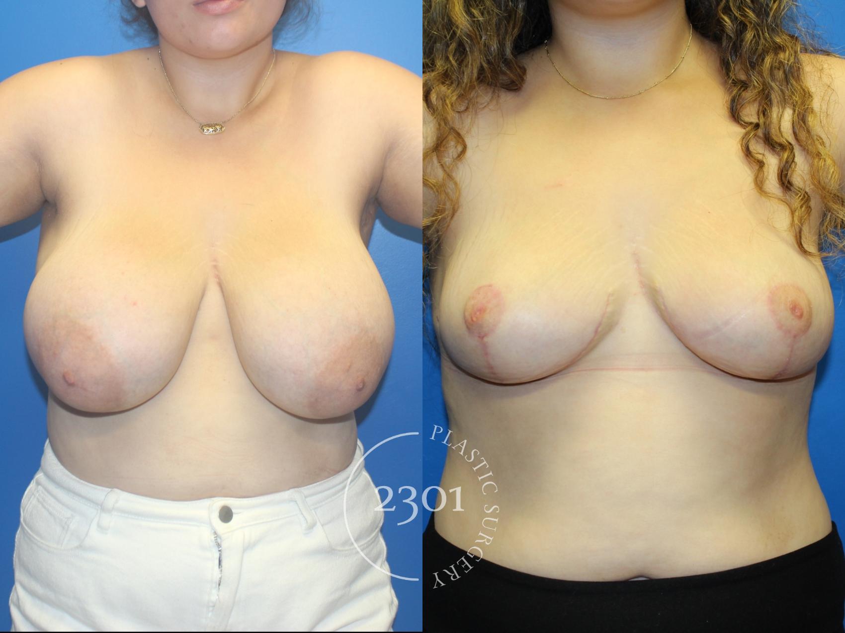 Before & After Breast Reduction Case 962 Front View in Fort Worth, Plano, & Frisco, Texas