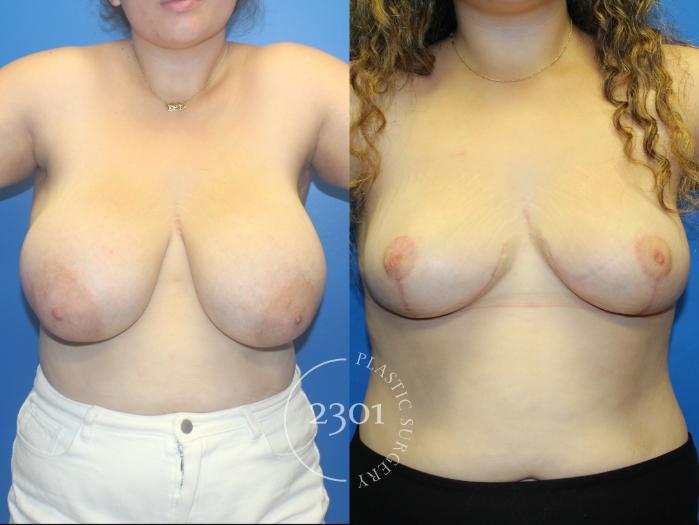 Before & After Breast Reduction Case 962 Front View in Fort Worth, Plano, & Frisco, Texas