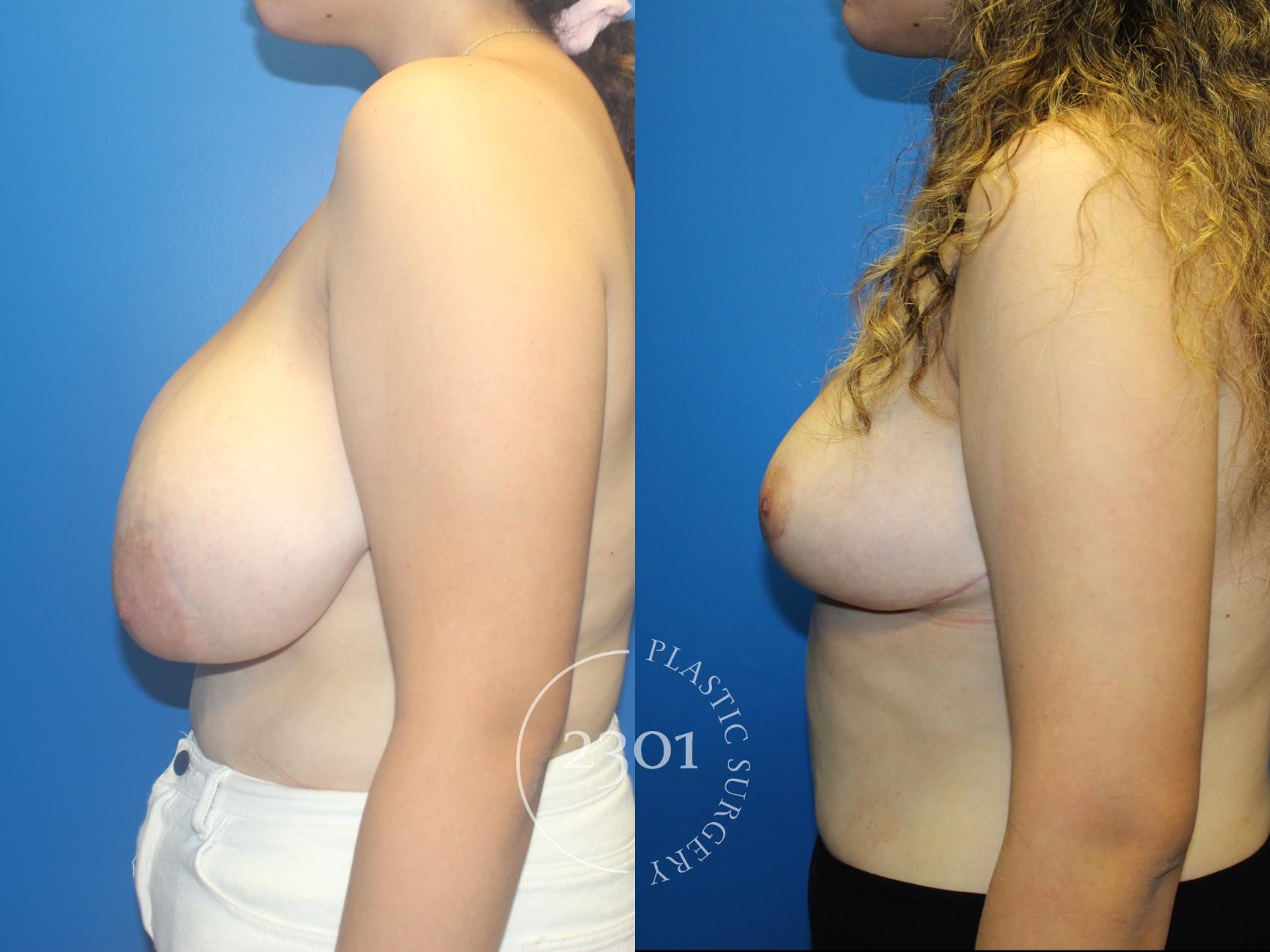 Before & After Breast Reduction Case 962 Left Side View in Fort Worth, Plano, & Frisco, Texas