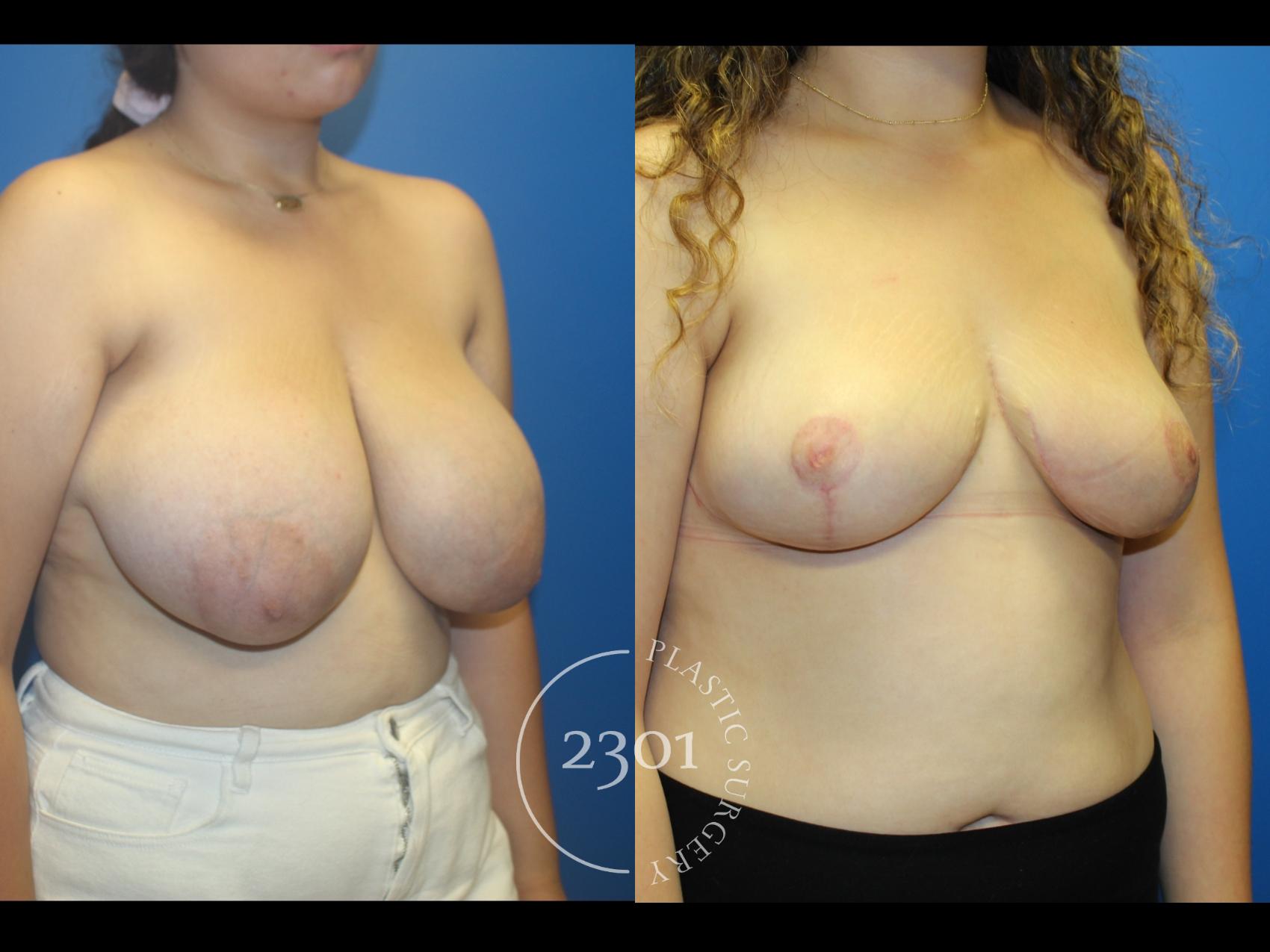 Before & After Breast Reduction Case 962 Right Oblique View in Fort Worth, Plano, & Frisco, Texas