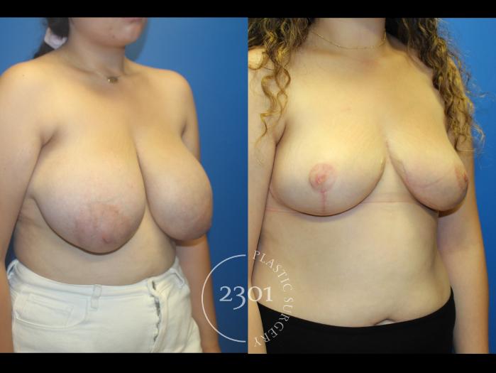 Before & After Breast Reduction Case 962 Right Oblique View in Fort Worth, Plano, & Frisco, Texas