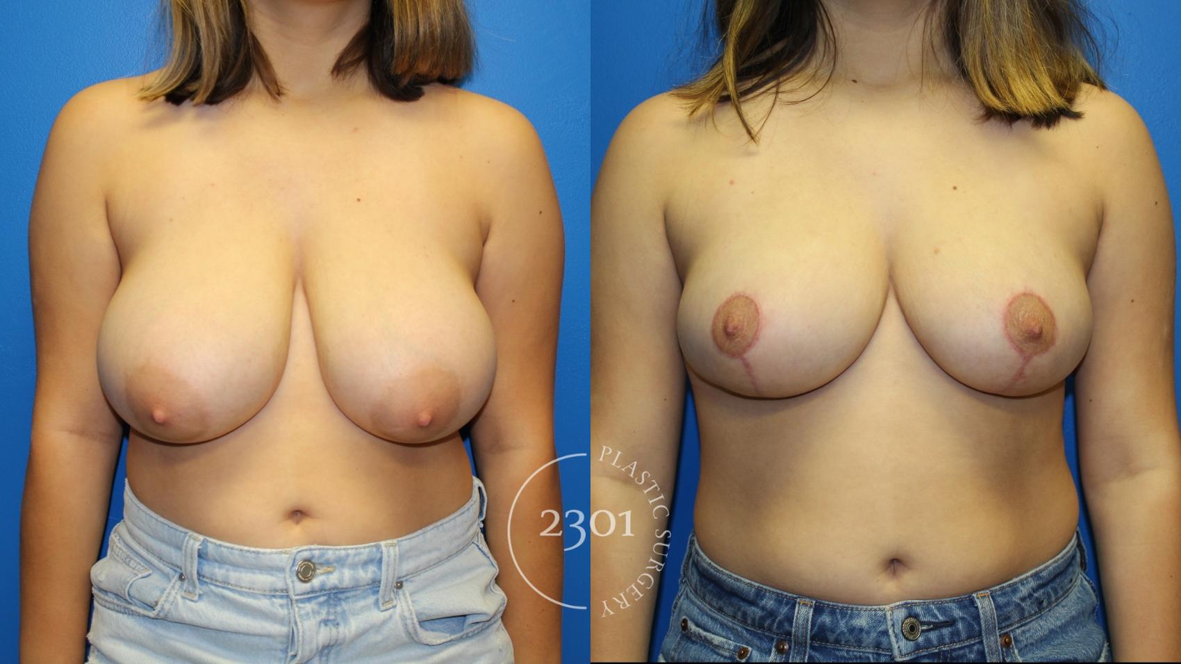 Before & After Breast Reduction Case 963 Front View in Fort Worth, Plano, & Frisco, Texas