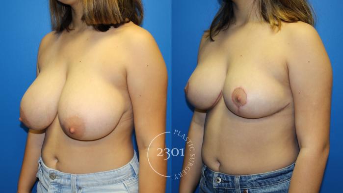 Before & After Breast Reduction Case 963 Left Oblique View in Fort Worth, Plano, & Frisco, Texas