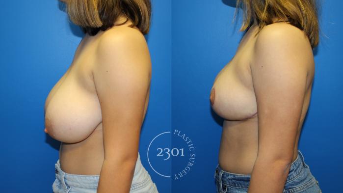 Before & After Breast Reduction Case 963 Left Side View in Fort Worth, Plano, & Frisco, Texas