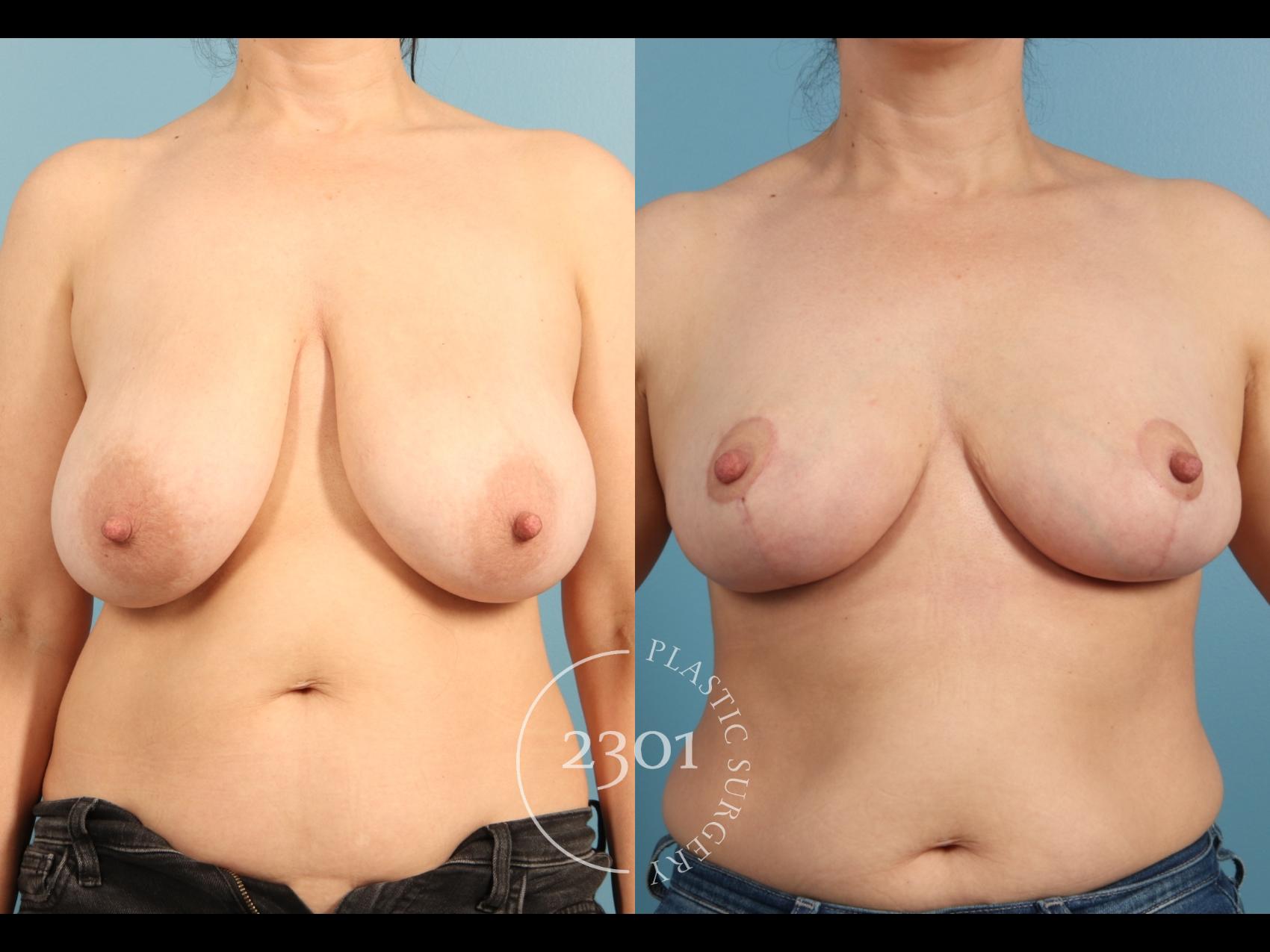 Before & After Breast Reduction Case 964 Front View in Fort Worth, Plano, & Frisco, Texas
