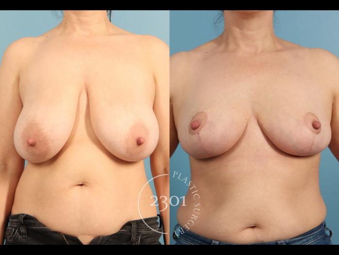 Before & After Breast Reduction Case 964 Front View in Fort Worth, Plano, & Frisco, Texas