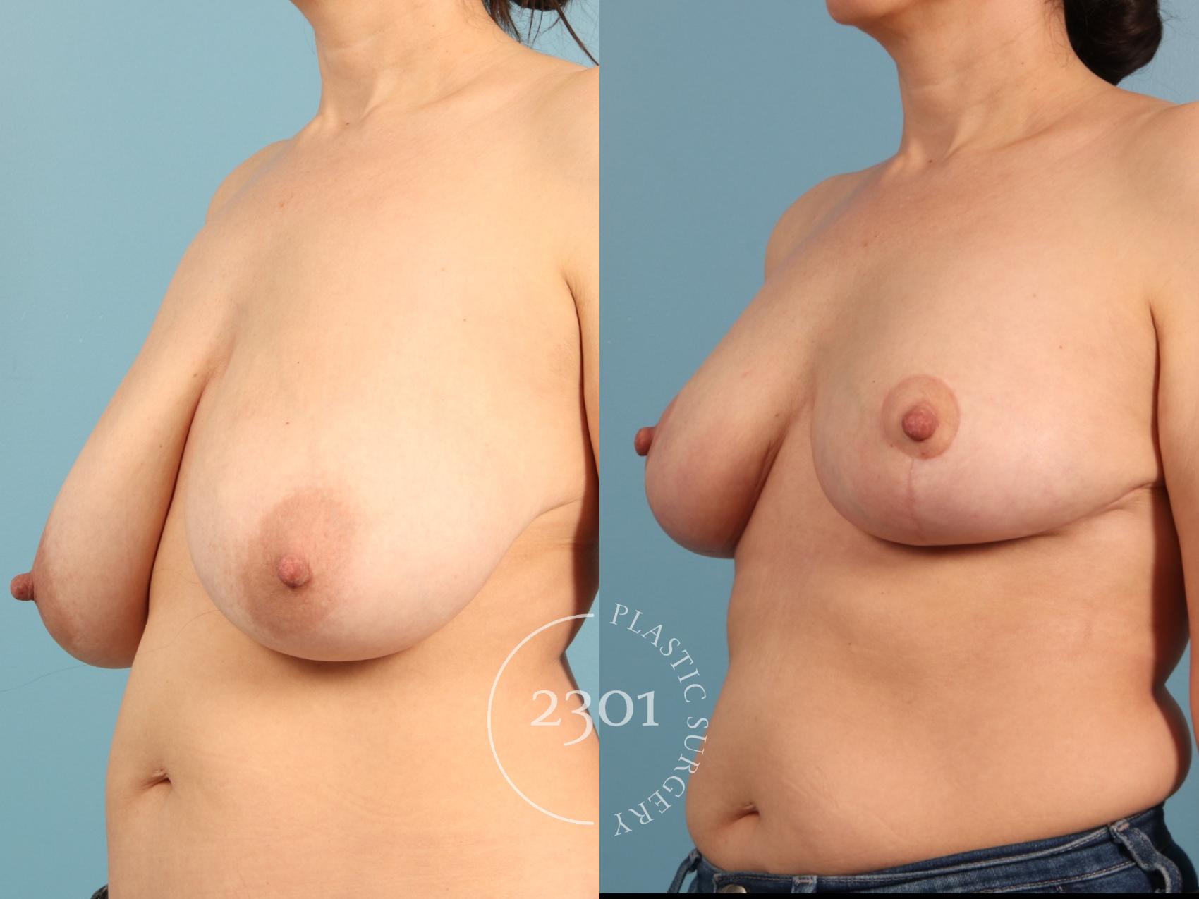 Before & After Breast Reduction Case 964 Left Oblique View in Fort Worth, Plano, & Frisco, Texas