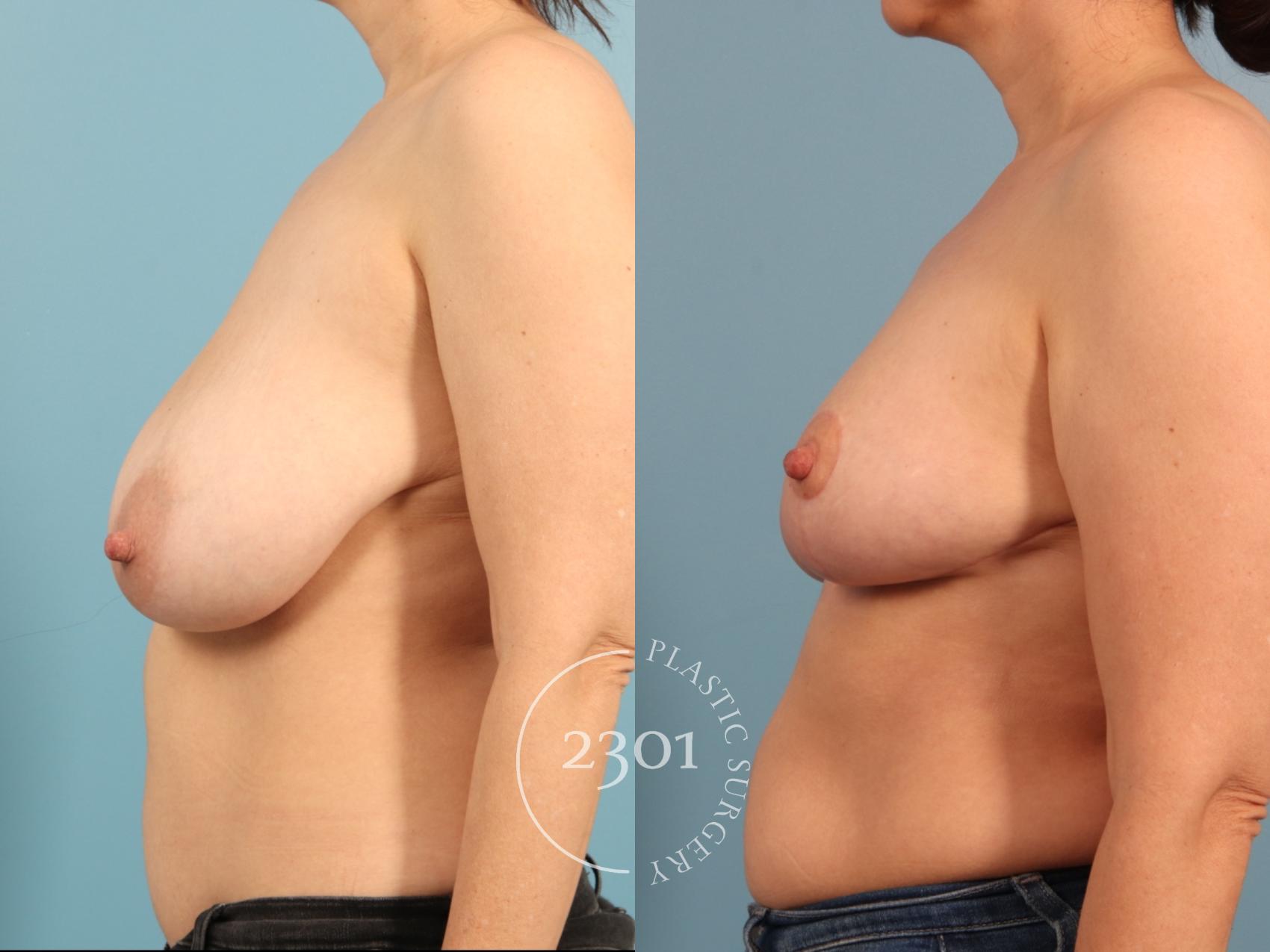 Before & After Breast Reduction Case 964 Left Side View in Fort Worth, Plano, & Frisco, Texas