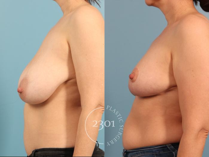 Before & After Breast Reduction Case 964 Left Side View in Fort Worth, Plano, & Frisco, Texas