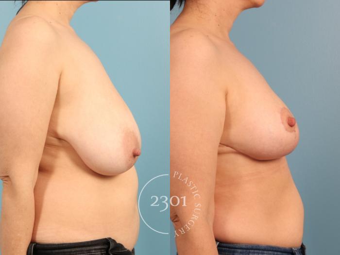 Before & After Breast Reduction Case 964 Right Side View in Fort Worth, Plano, & Frisco, Texas