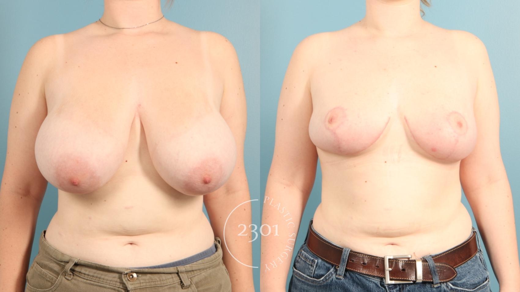 Before & After Breast Reduction Case 965 Front View in Fort Worth, Plano, & Frisco, Texas