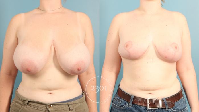Before & After Breast Reduction Case 965 Front View in Fort Worth, Plano, & Frisco, Texas