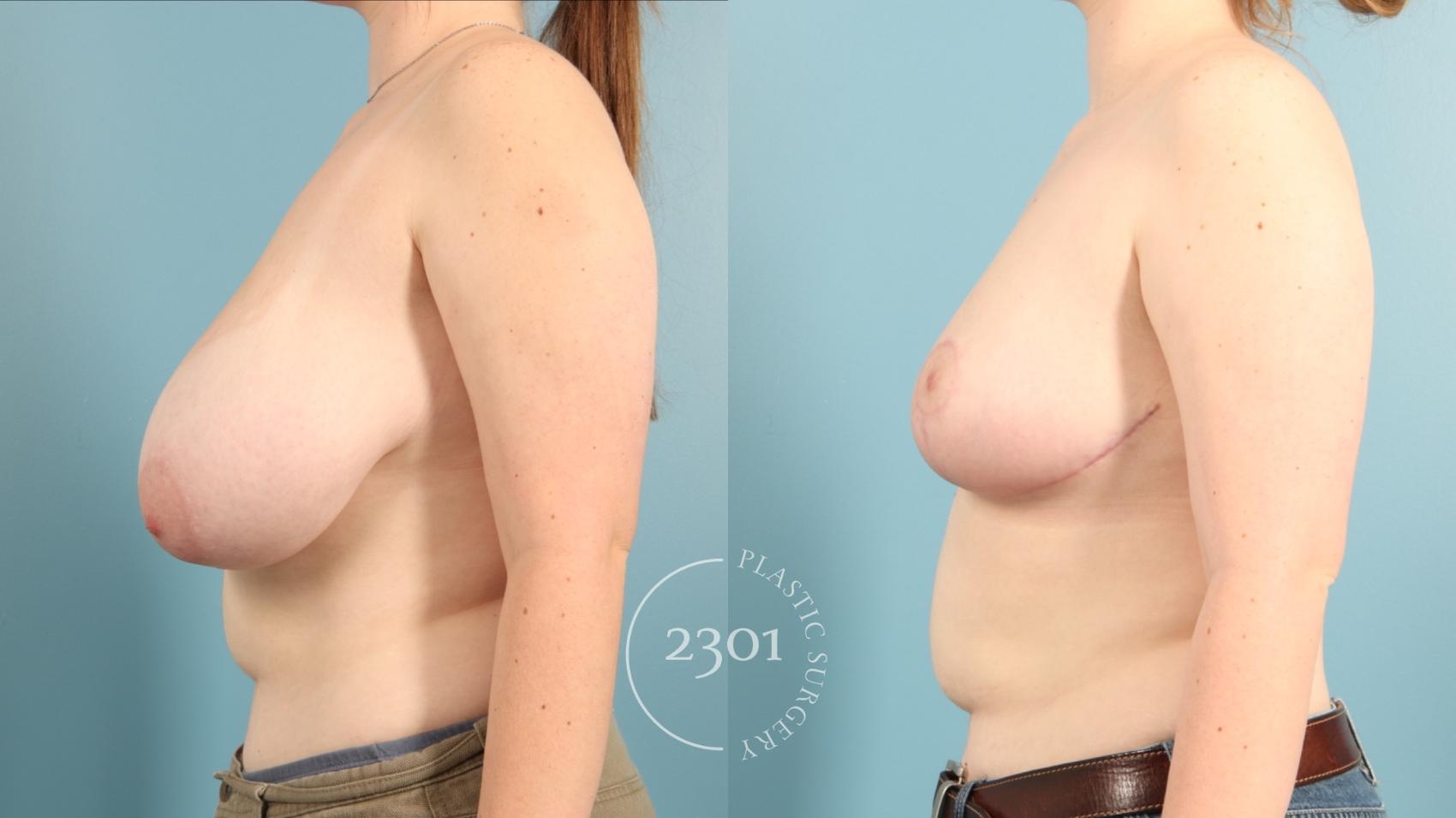 Before & After Breast Reduction Case 965 Left Oblique View in Fort Worth, Plano, & Frisco, Texas