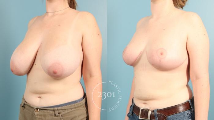 Before & After Breast Reduction Case 965 Left Side View in Fort Worth, Plano, & Frisco, Texas