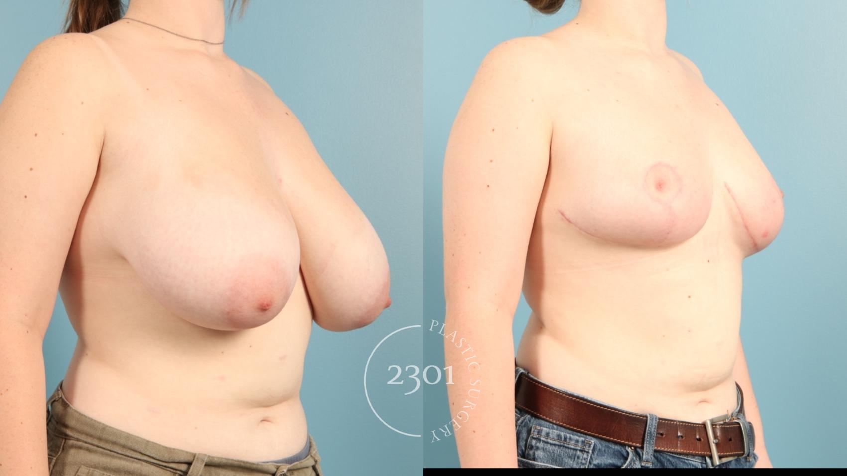 Before & After Breast Reduction Case 965 Right Oblique View in Fort Worth, Plano, & Frisco, Texas