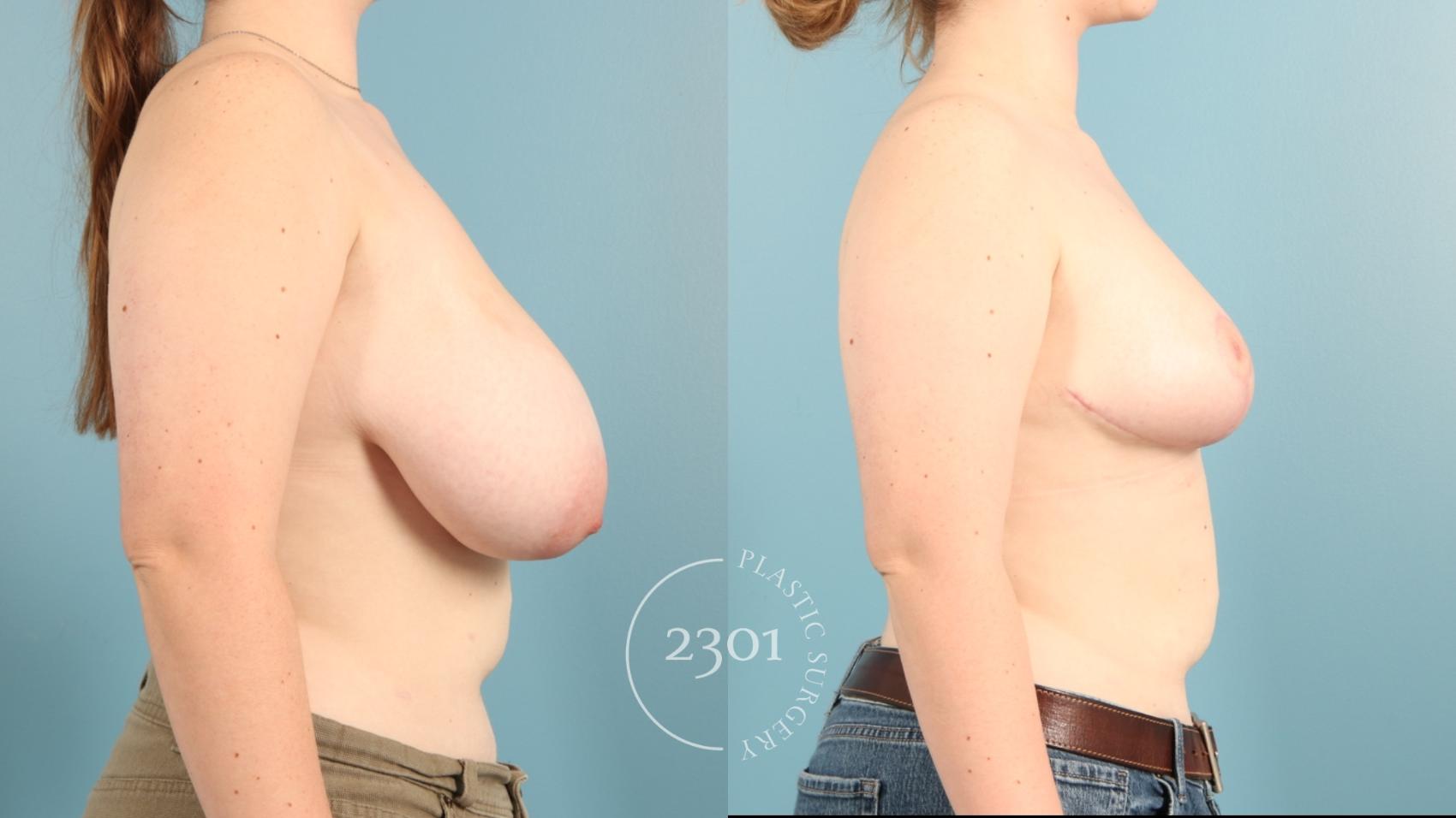 Before & After Breast Reduction Case 965 Right Side View in Fort Worth, Plano, & Frisco, Texas