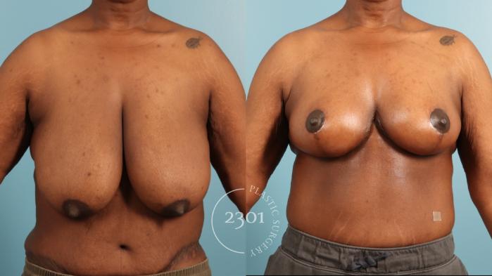 Before & After Breast Reduction Case 970 Front View in Fort Worth, Plano, & Frisco, Texas