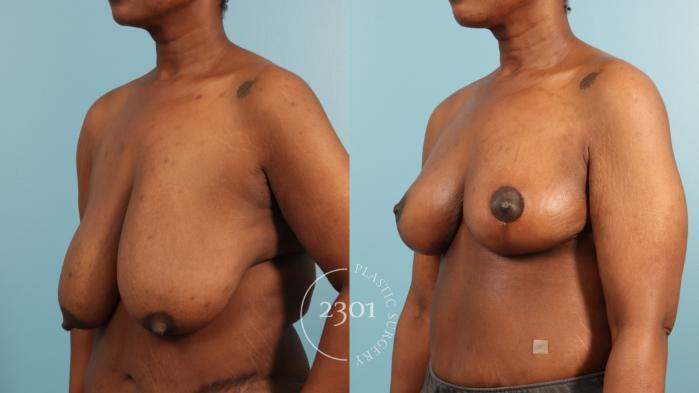Before & After Breast Reduction Case 970 Left Oblique View in Fort Worth, Plano, & Frisco, Texas