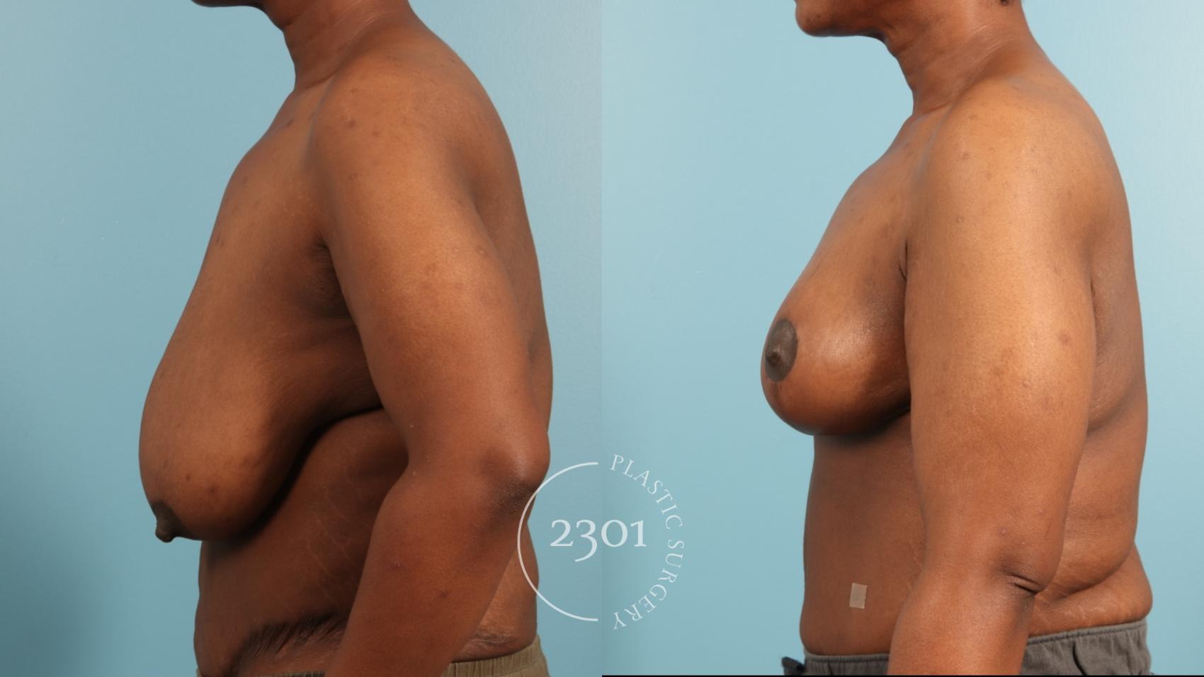 Before & After Breast Reduction Case 970 Left Side View in Fort Worth, Plano, & Frisco, Texas