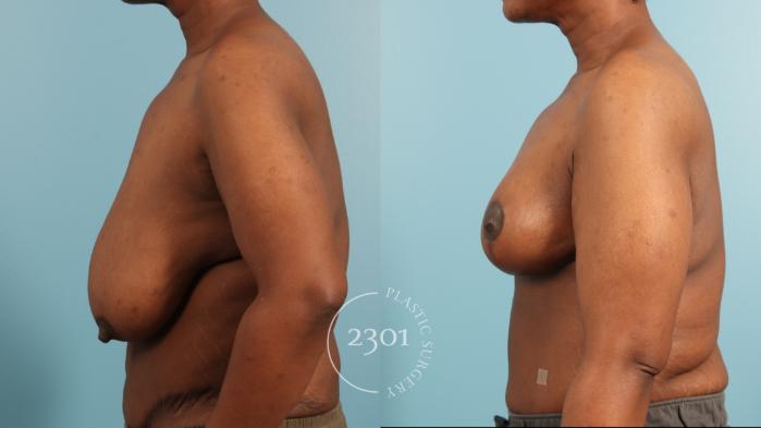 Before & After Breast Reduction Case 970 Left Side View in Fort Worth, Plano, & Frisco, Texas