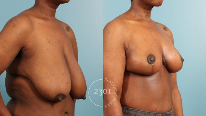 Before & After Breast Reduction Case 970 Right Oblique View in Fort Worth, Plano, & Frisco, Texas