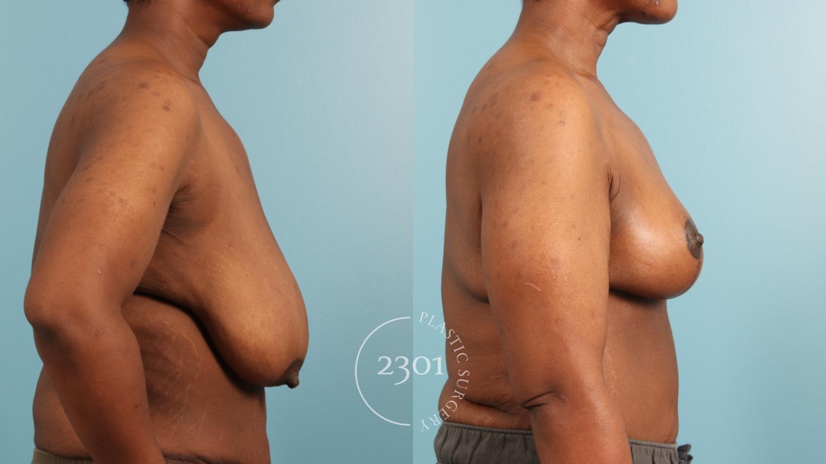 Before & After Breast Reduction Case 970 Right Side View in Fort Worth, Plano, & Frisco, Texas