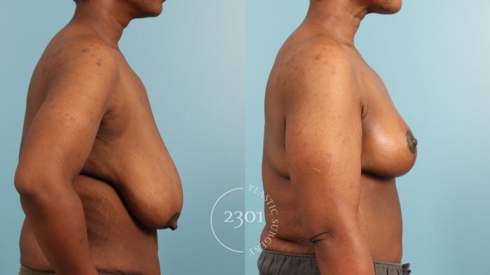 Before & After Breast Reduction Case 970 Right Side View in Fort Worth, Plano, & Frisco, Texas
