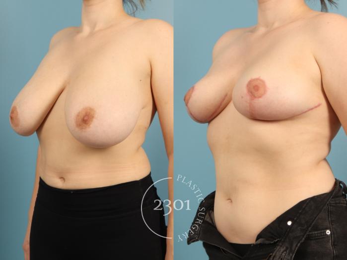 Before & After Breast Reduction Case 974 Left Side View in Fort Worth, Plano, & Frisco, Texas