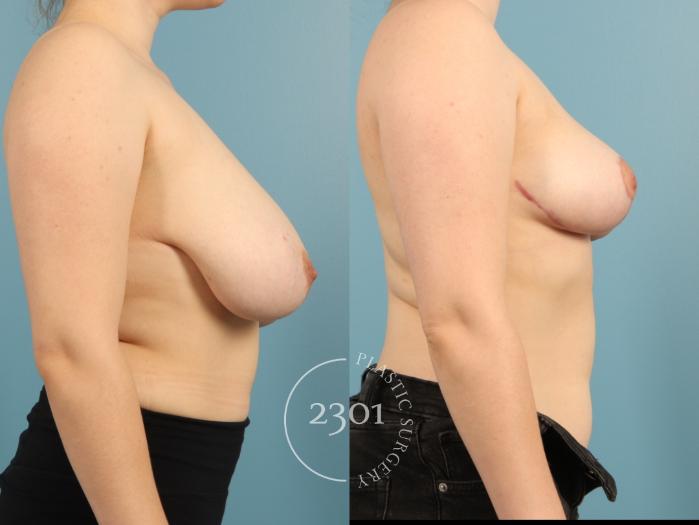 Before & After Breast Reduction Case 974 Right Side View in Fort Worth, Plano, & Frisco, Texas