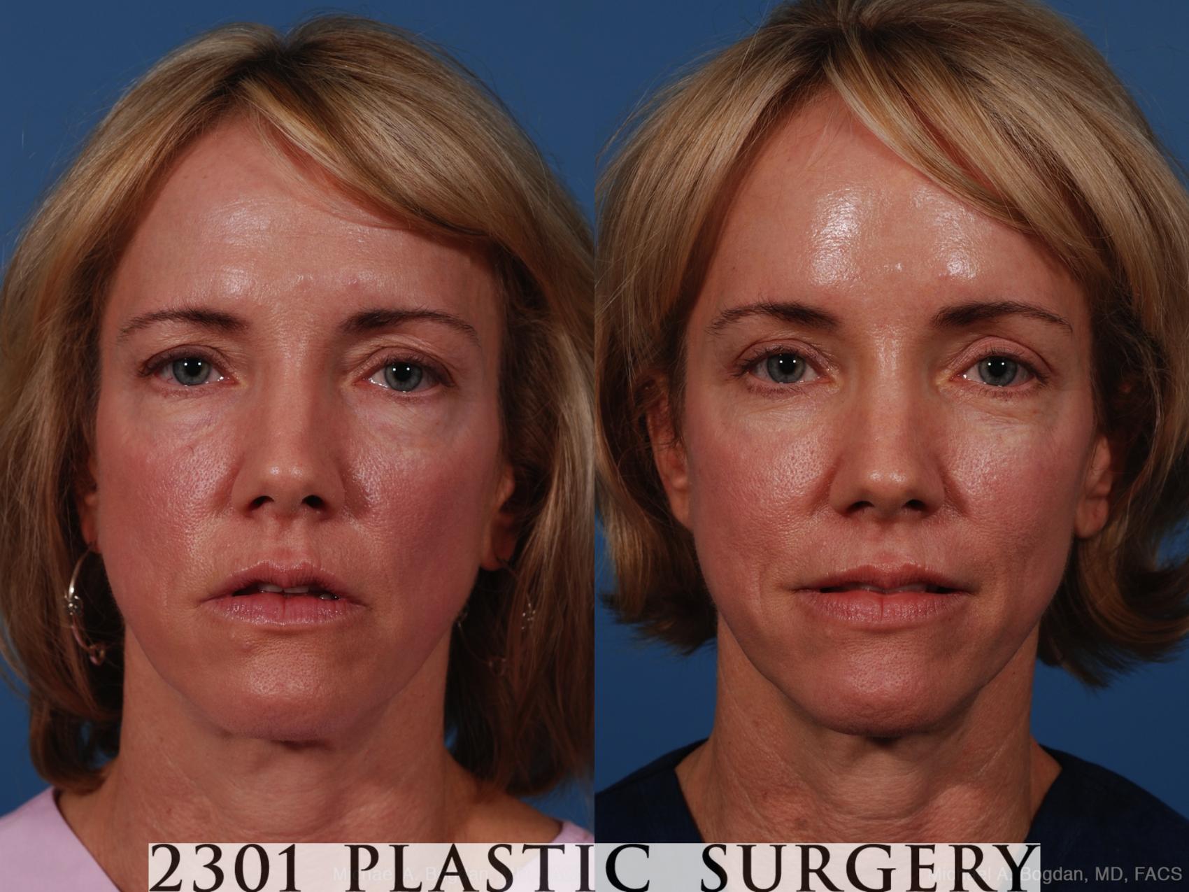 Before & After Brow Lift Case 263 View #1 View in Fort Worth & Frisco, Texas