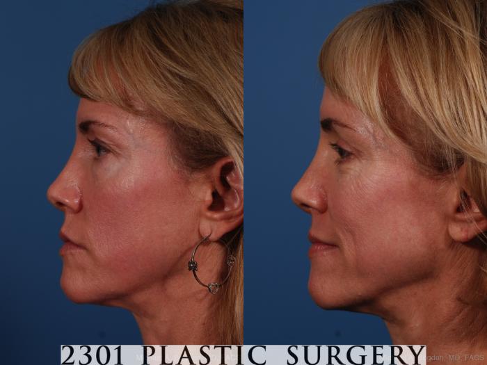 Before & After Blepharoplasty Case 263 View #2 View in Fort Worth, Plano, & Frisco, Texas