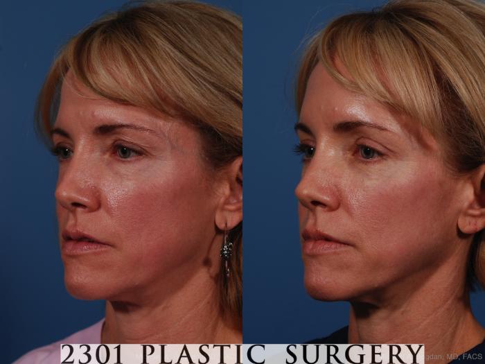 Before & After Brow Lift Case 263 View #3 View in Fort Worth, Plano, & Frisco, Texas