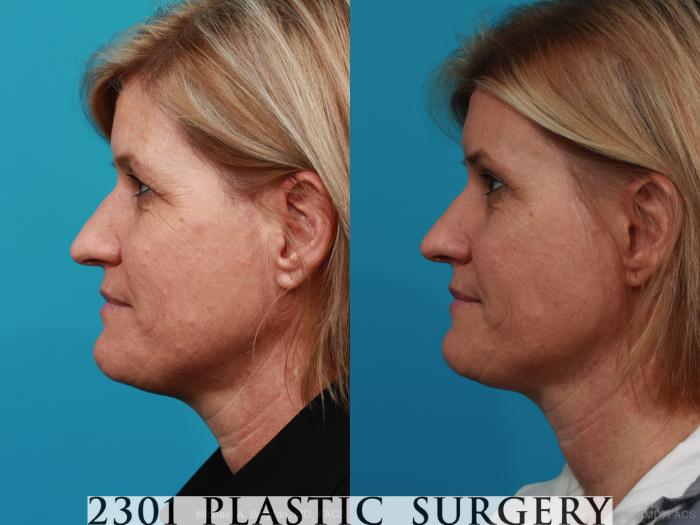 Before & After Brow Lift Case 299 View #2 View in Fort Worth, Plano, & Frisco, Texas