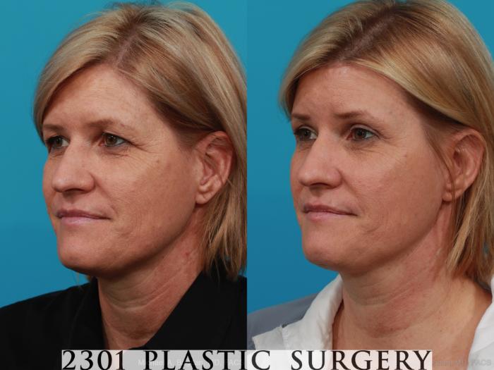 Before & After Blepharoplasty Case 299 View #3 View in Fort Worth, Plano, & Frisco, Texas