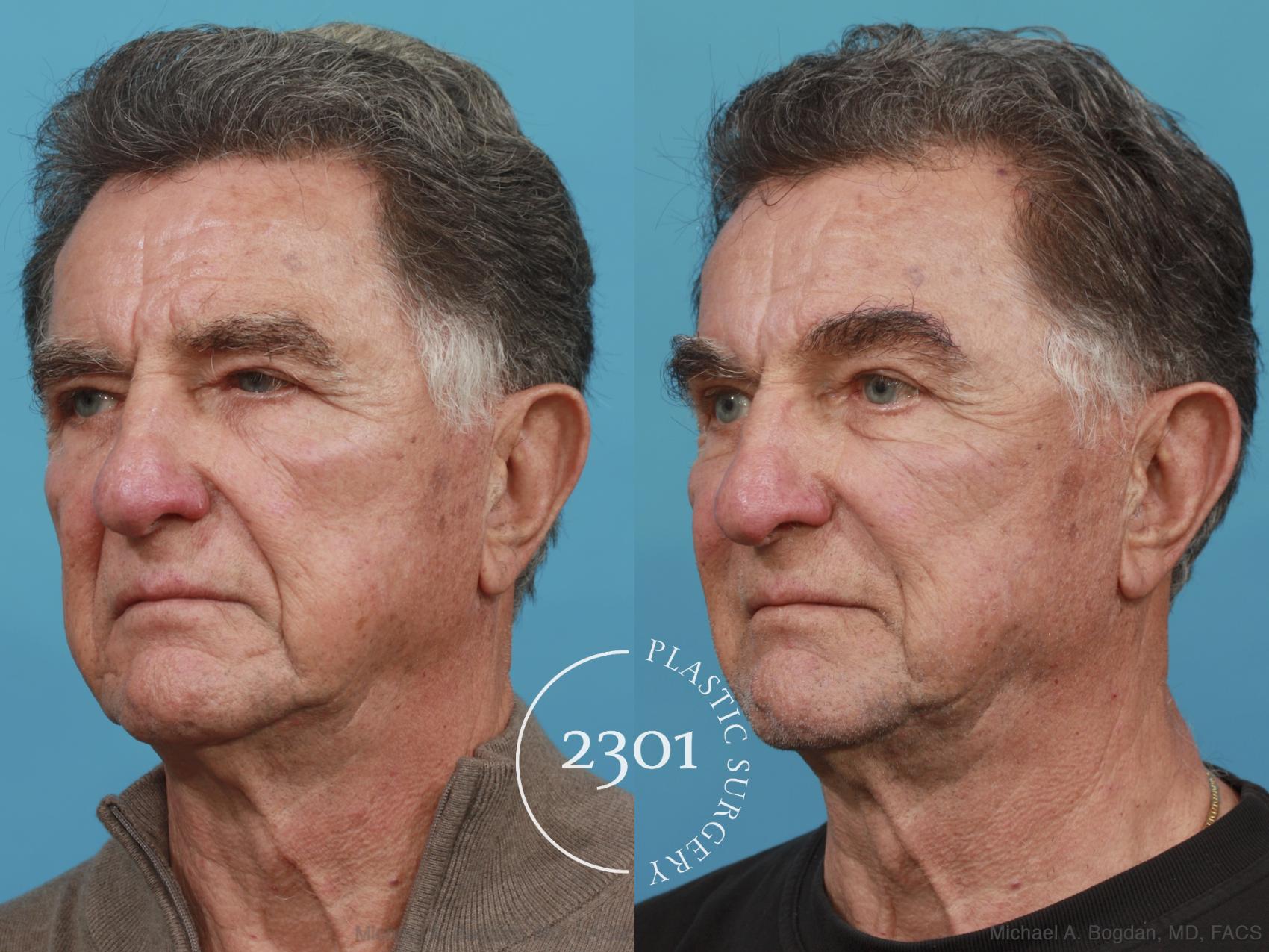Before & After Brow Lift Case 539 View #2 View in Fort Worth, Plano, & Frisco, Texas