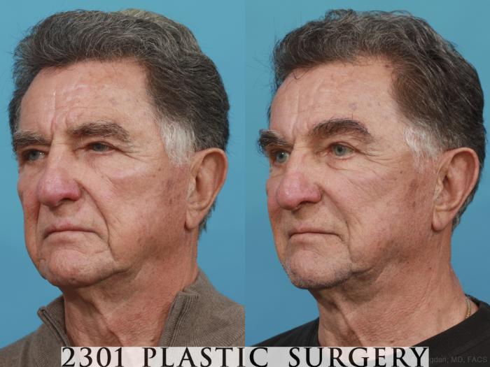 Before & After Brow Lift Case 539 View #2 View in Fort Worth, Plano, & Frisco, Texas