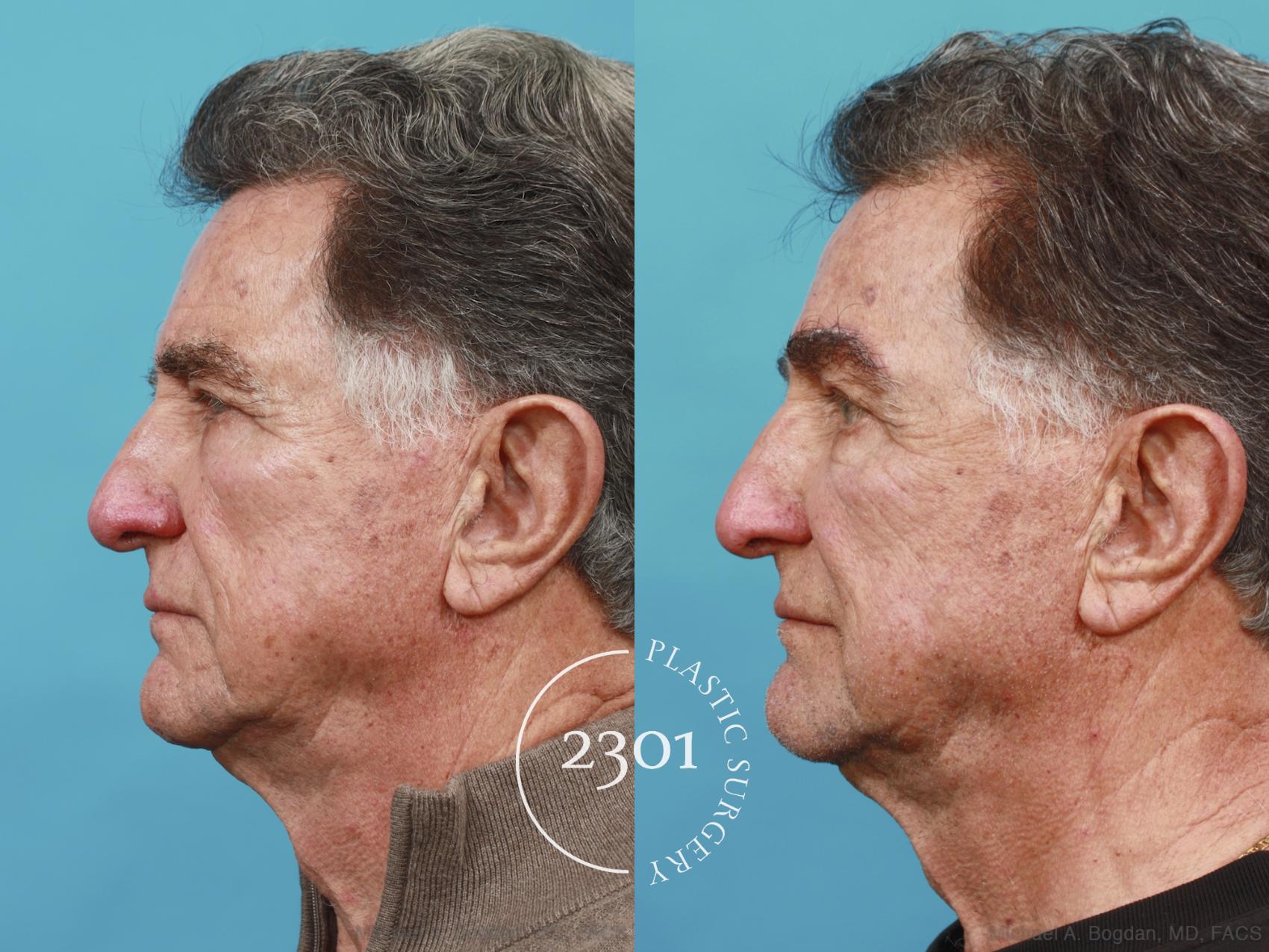 Before & After Brow Lift Case 539 View #3 View in Fort Worth, Plano, & Frisco, Texas