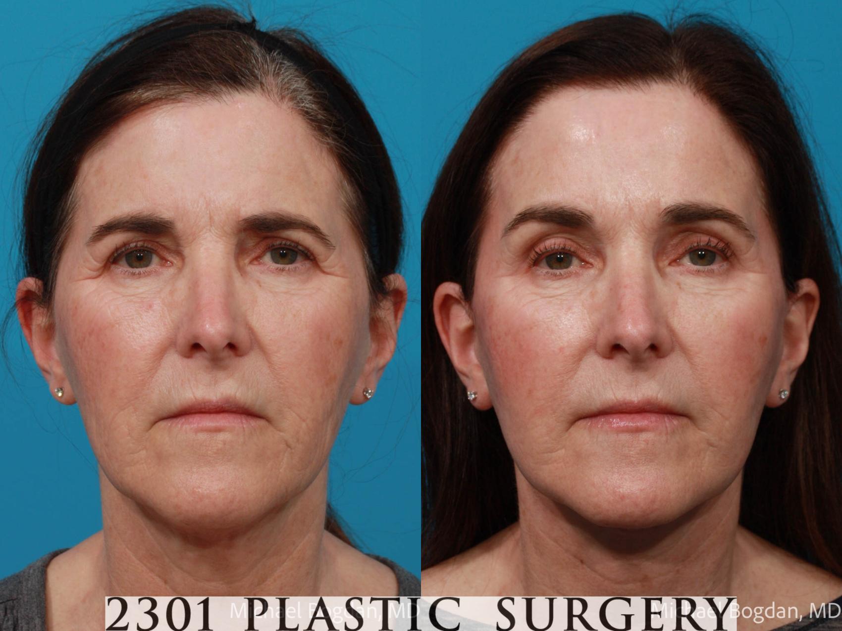Before & After Face Lift Case 691 Front View in Fort Worth & Frisco, Texas