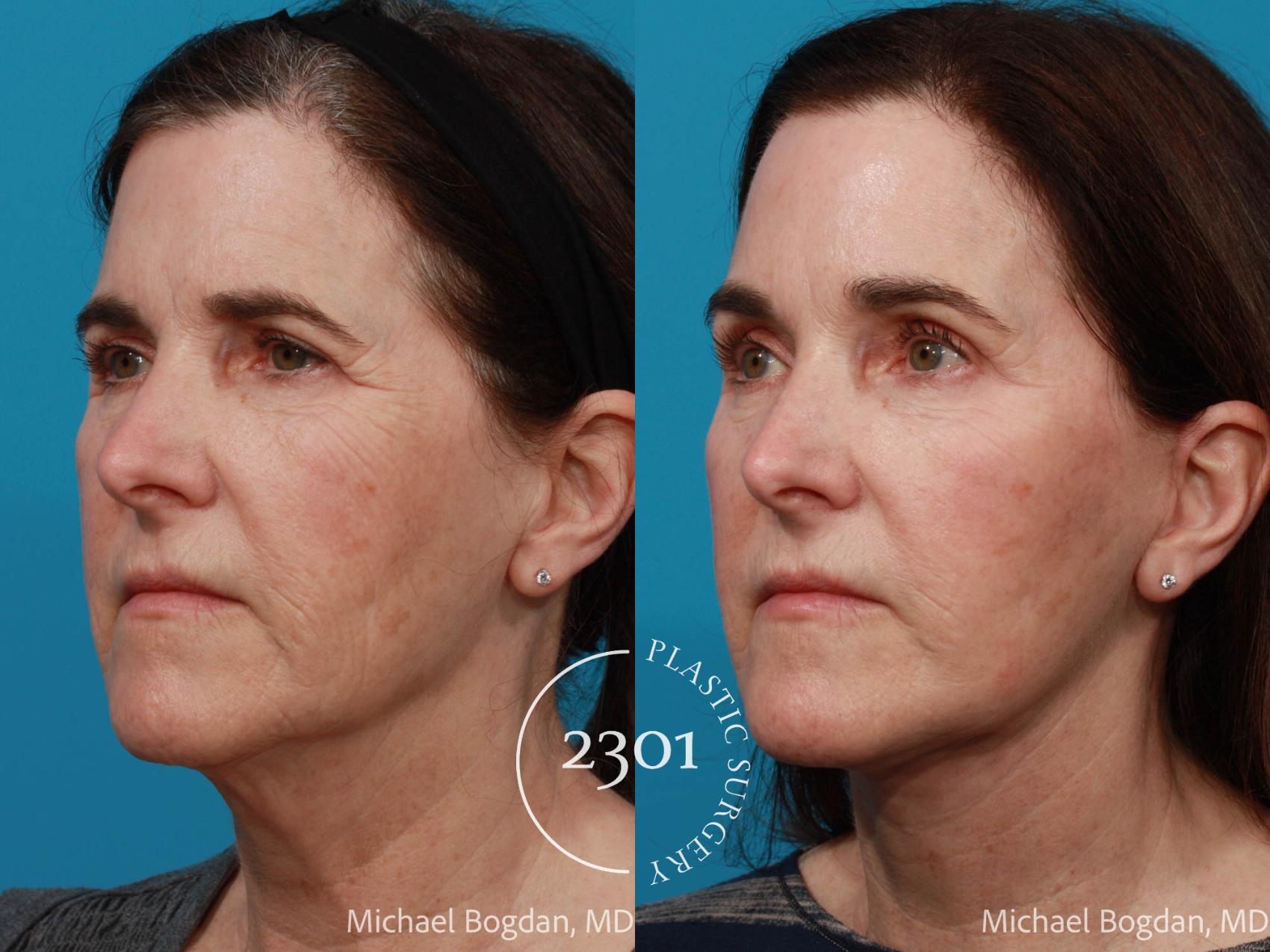 Before & After Face Lift Case 691 Left Oblique View in Fort Worth, Plano, & Frisco, Texas