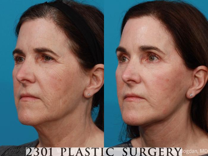 Before & After Brow Lift Case 691 Left Oblique View in Fort Worth, Plano, & Frisco, Texas