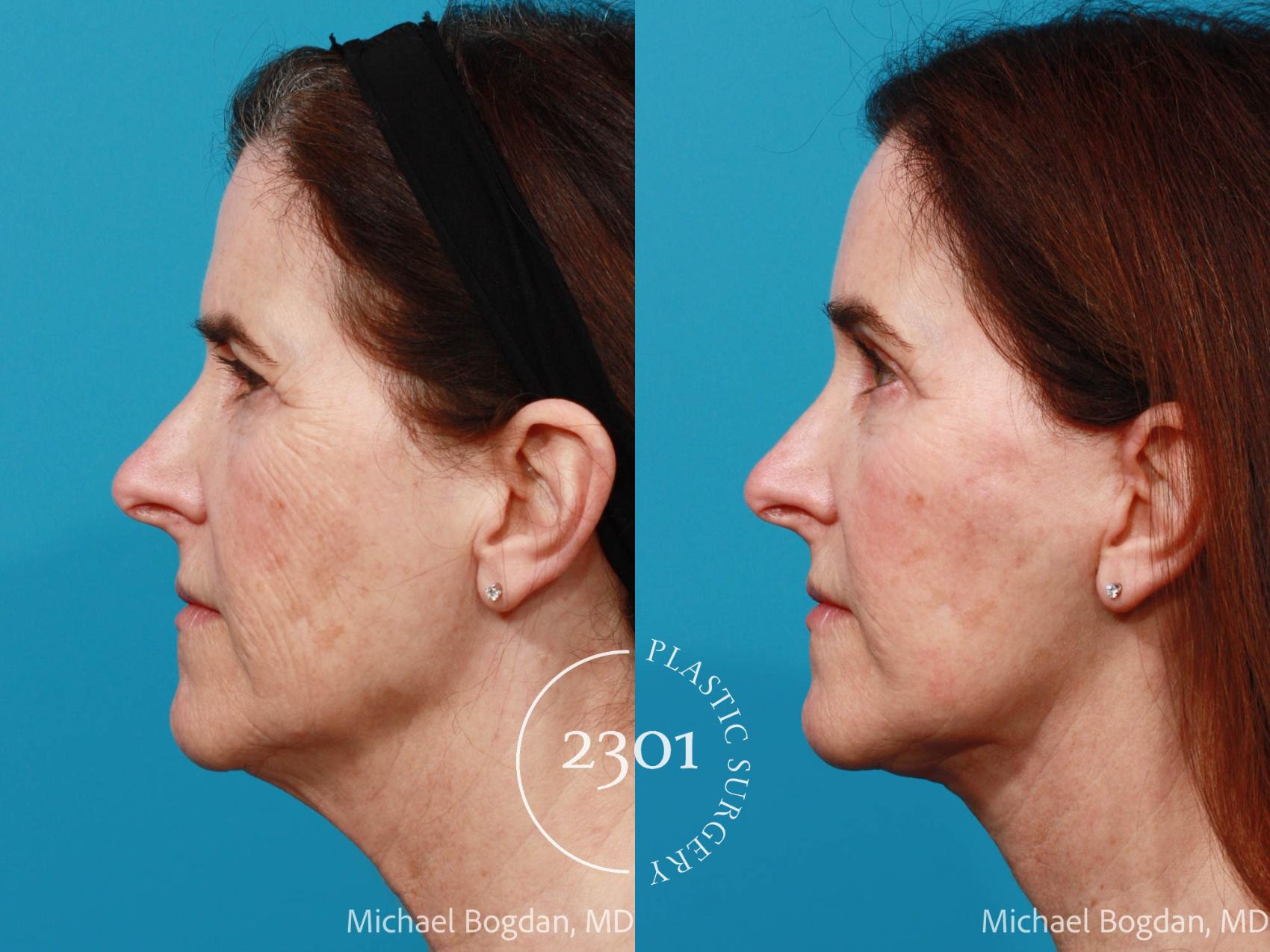 Before & After Face Lift Case 691 Left Side View in Fort Worth, Plano, & Frisco, Texas
