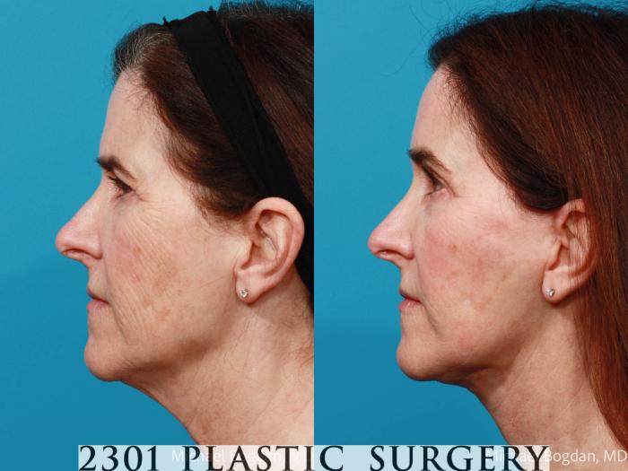 Before & After Face Lift Case 691 Left Side View in Fort Worth, Plano, & Frisco, Texas