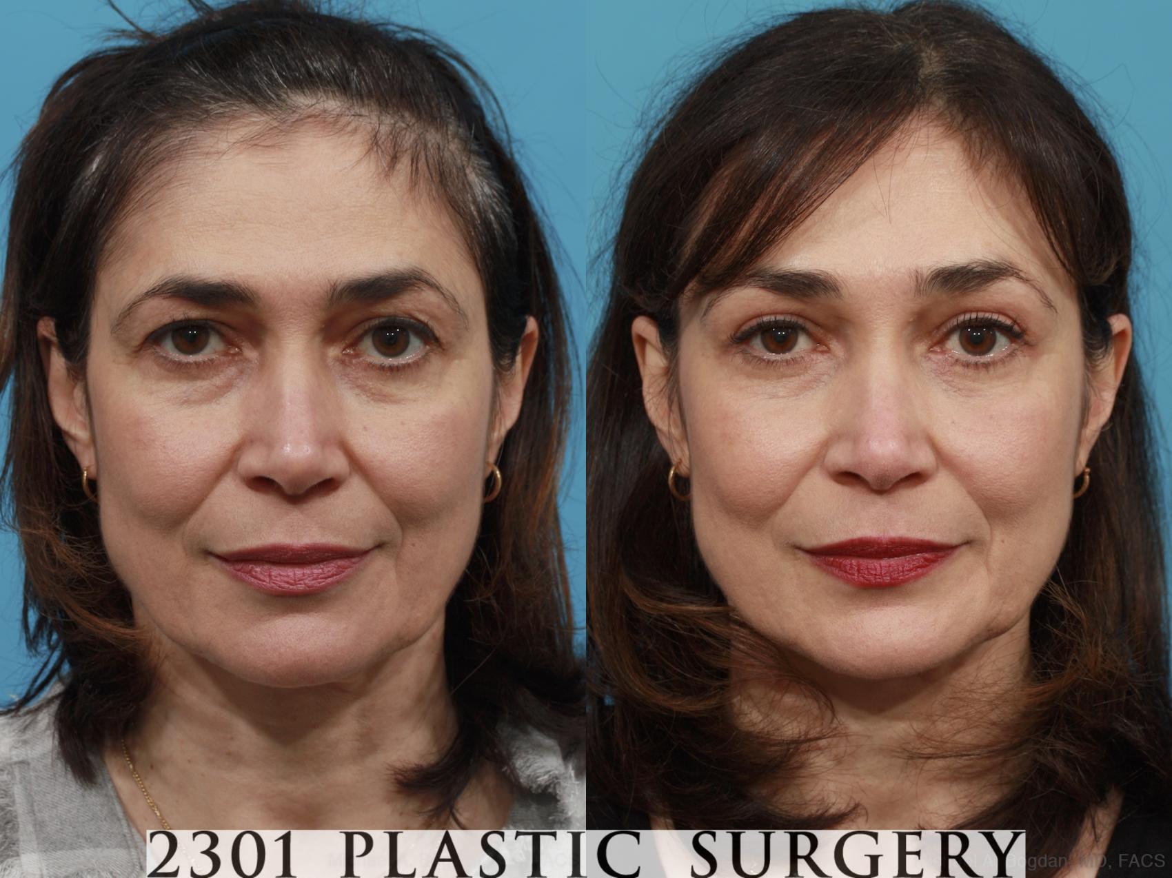 Before & After Blepharoplasty Case 470 View #1 View in Fort Worth & Frisco, Texas