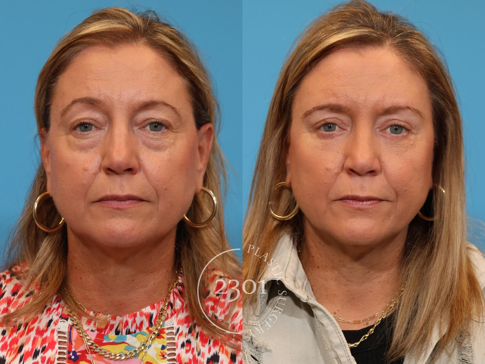 Before & After Blepharoplasty Case 912 Front View in Fort Worth, Plano, & Frisco, Texas