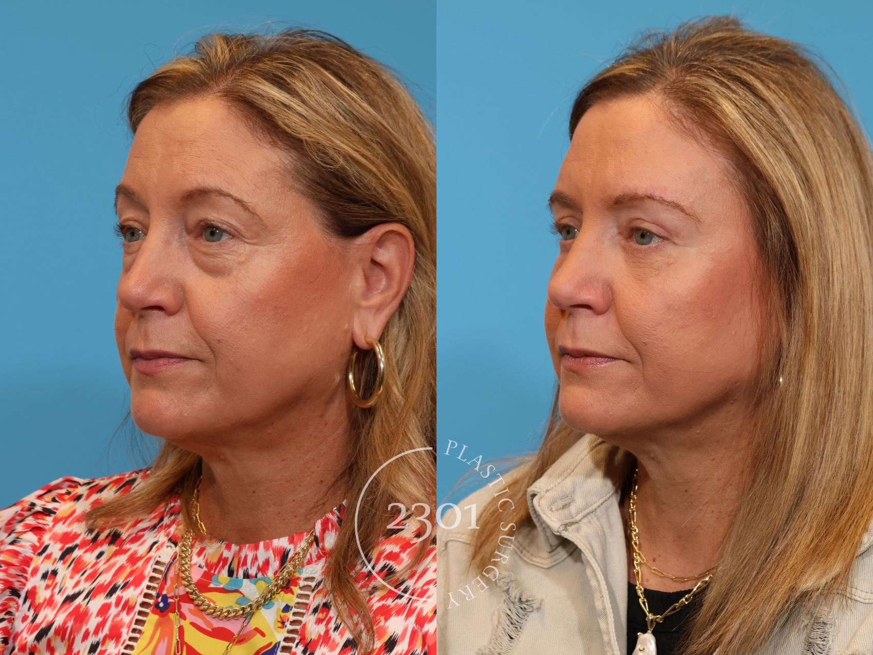 Before & After Blepharoplasty Case 912 Left Oblique View in Fort Worth, Plano, & Frisco, Texas