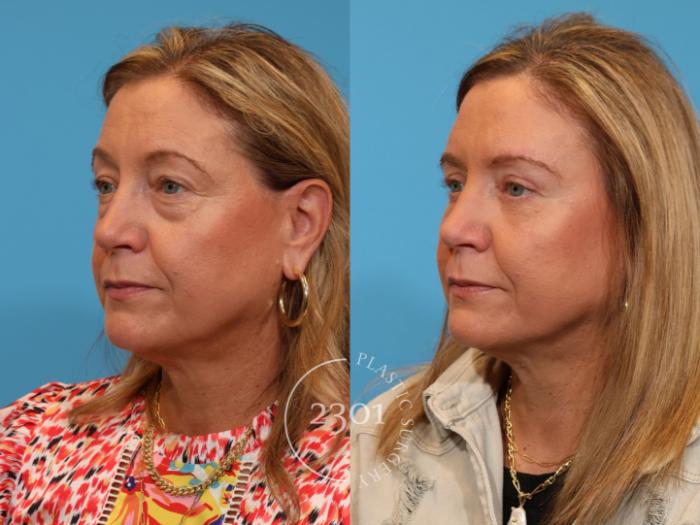 Before & After Blepharoplasty Case 912 Left Oblique View in Fort Worth, Plano, & Frisco, Texas