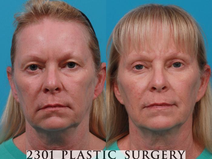 Before & After Eyelid Surgery (Upper) Case 725 Front View in Fort Worth, Plano, & Frisco, Texas